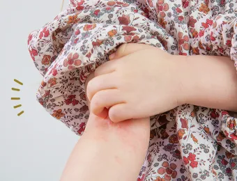 アトピー性皮膚炎